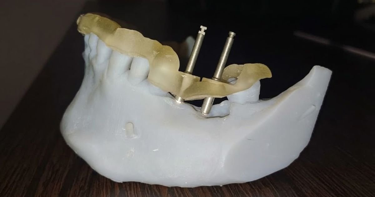 Implantes sin cortes ni suturas: la cirugía guiada digital